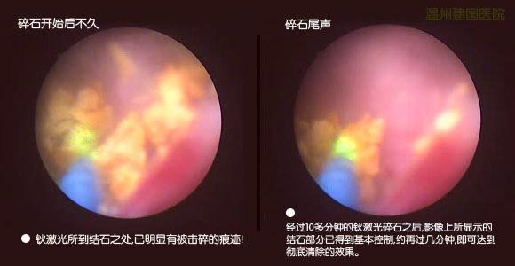 小小输尿管结石 危害却是致命的！