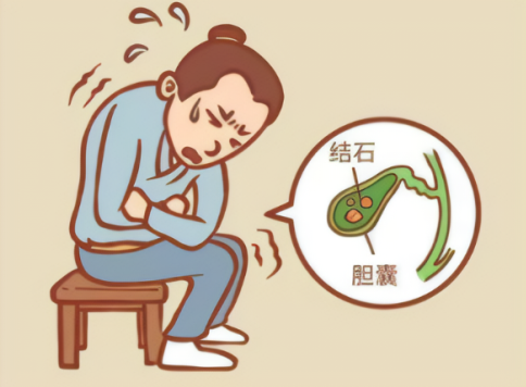 胆囊结石患者的“重生”之路